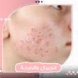 أفضل طرق إزالة آثار حب الشباب والندبات البنية
